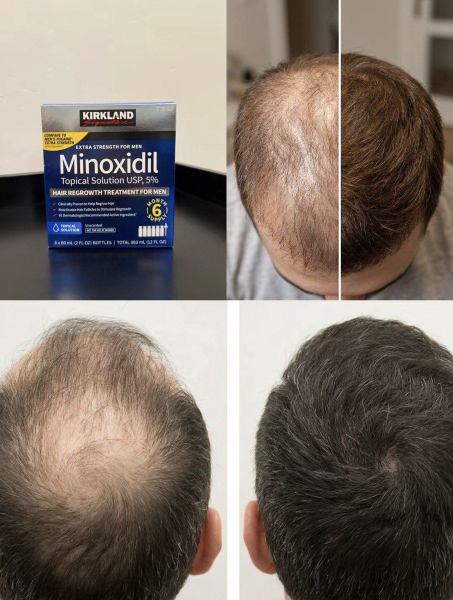 Saç serumu "Minoxidil Kirkland" — Gözəllik və səhiyyə, Bakı (3)