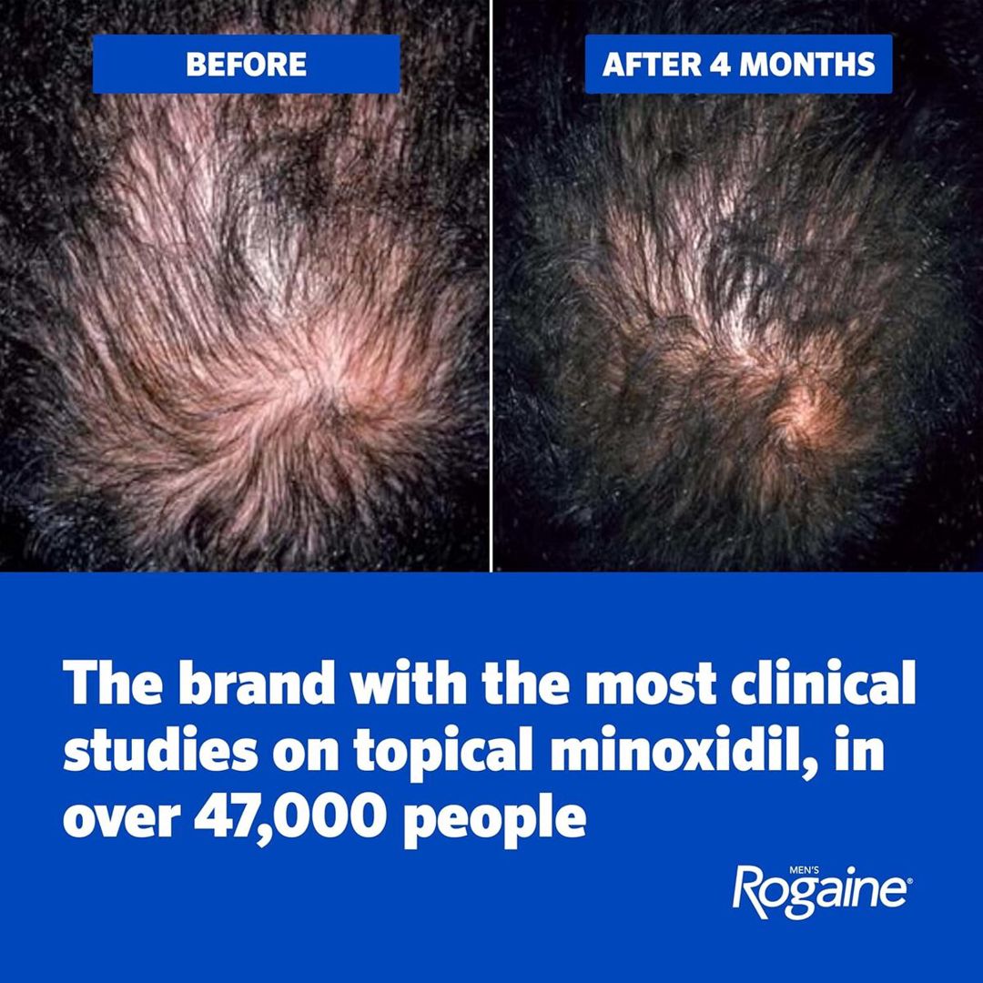 Topical Solution Rogaine — Gözəllik və səhiyyə, Bakı (10)