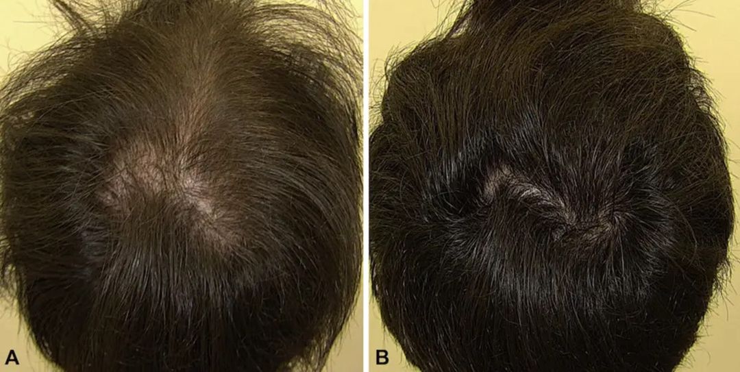Topical Solution Rogaine — Gözəllik və səhiyyə, Bakı (4)