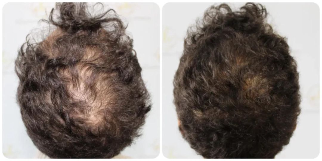 Topical Solution Rogaine — Gözəllik və səhiyyə, Bakı (3)