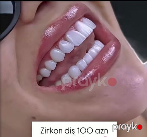 Xidmət: Zirkon diş Təsvir: - Estetik və möhkəm zirkon bərpalar — Bakı