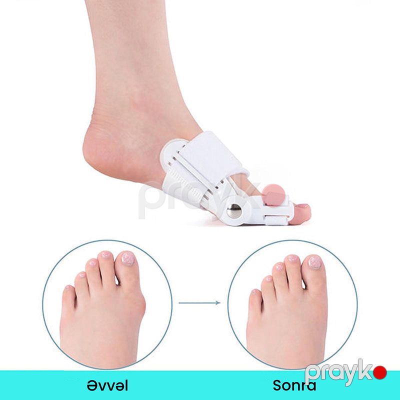 2 Ədəd Bunion Korrektoru – Hallux Valgus Üçün Professional Ayaq Barmağı Düzləşdirici Şin — Ev texnikası, Bakı (6)