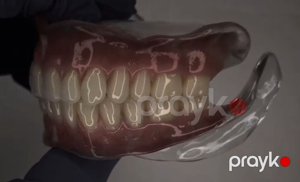 Tam üst-alt protez dəsti – anatomik detallı, yüksək estetikalı — Xidmətlər, Bakı (6)
