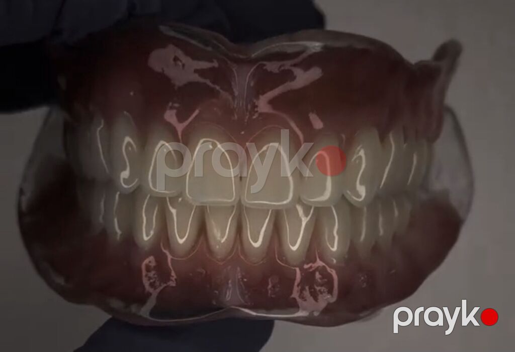 Tam üst-alt protez dəsti – anatomik detallı, yüksək estetikalı — Xidmətlər, Bakı (4)