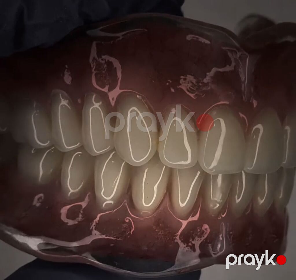 Tam üst-alt protez dəsti – anatomik detallı, yüksək estetikalı — Xidmətlər, Bakı (5)