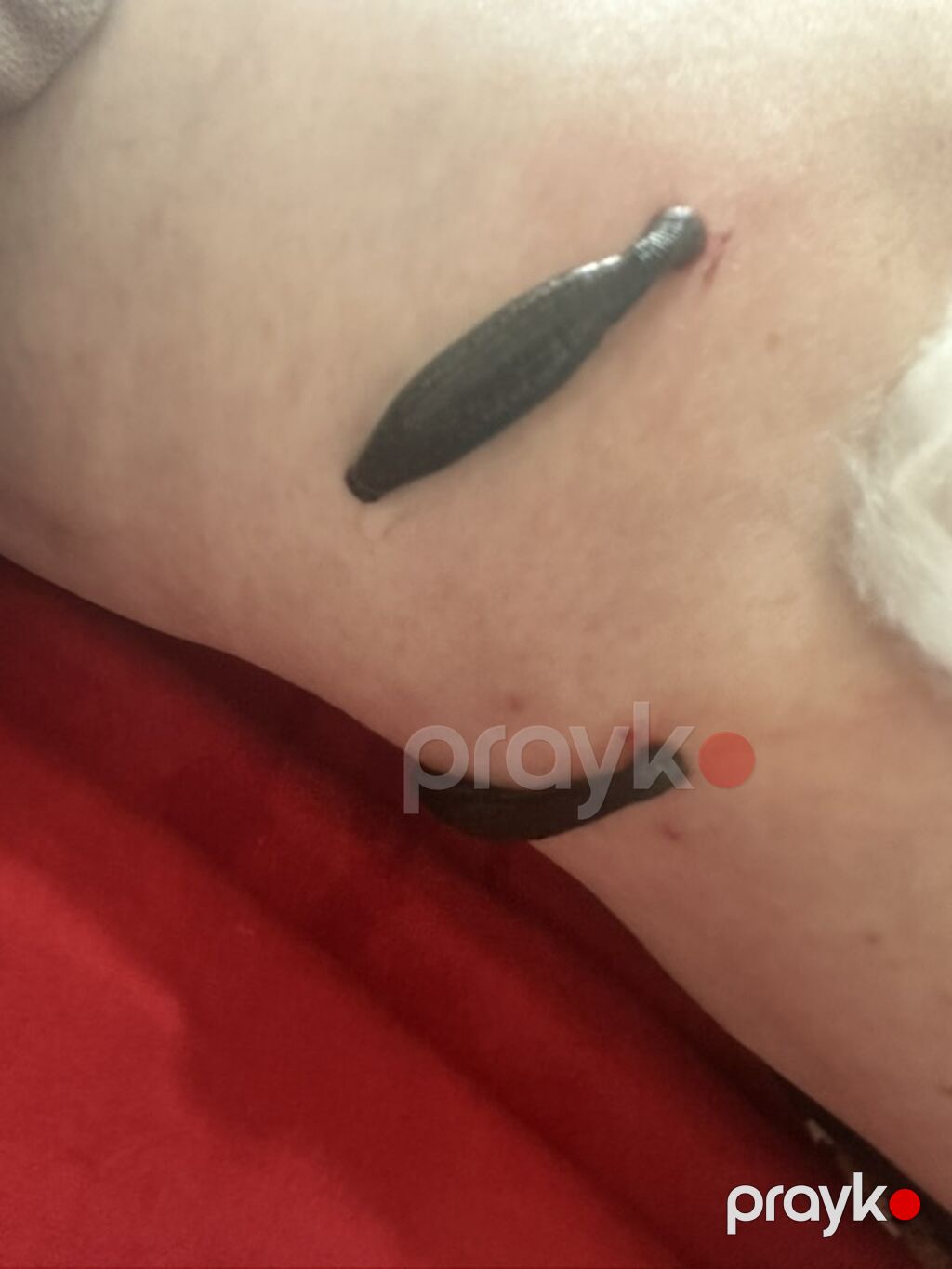 Hirudoterapiya xidməti – tibbi zəli ilə seanslar Təqdim edilir: - Üz — Digər, Bakı (2)