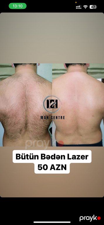Kişilər üçün lazer epilyasiyası xidməti — Digər, Bakı (3)
