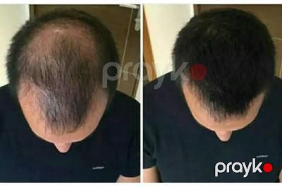 "Extra Hair" serumu — Gözəllik və səhiyyə, Bakı (6)