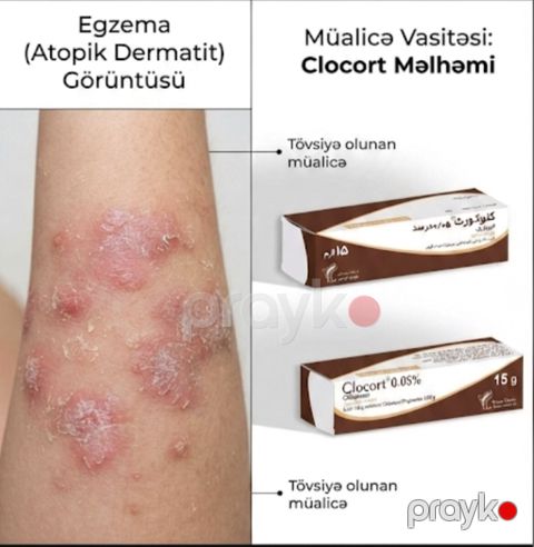 Ekzema sədəf psarioz məlhəmi — Bakı