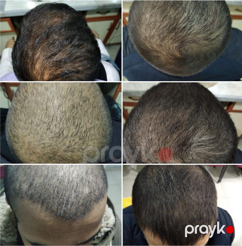 "Extra Hair" serumu — Gözəllik və səhiyyə, Bakı (7)