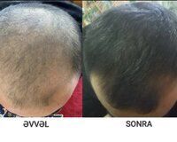 "Extra Hair" serumu — Gözəllik və səhiyyə, Bakı (4)