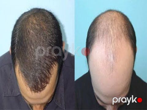 "Extra Hair" serumu — Gözəllik və səhiyyə, Bakı (5)