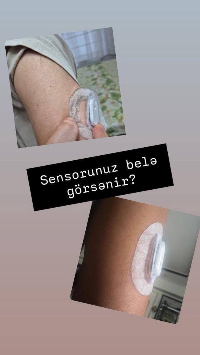 Elastik qol bandı Sıbıonıcs — Gözəllik və səhiyyə, Bakı (2)