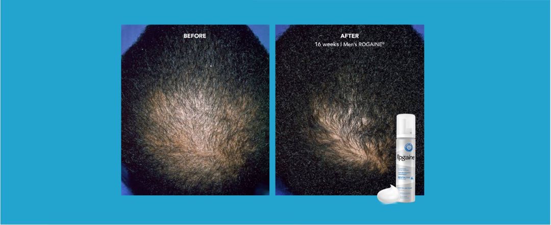 Köpük Rogaine 5% Minoxidil — Gözəllik və səhiyyə, Bakı (7)