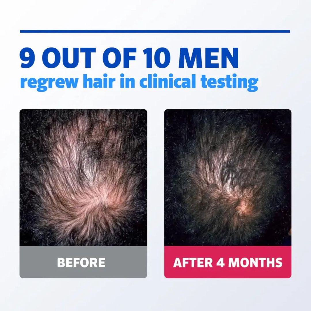 Köpük Rogaine 5% Minoxidil — Gözəllik və səhiyyə, Bakı (4)