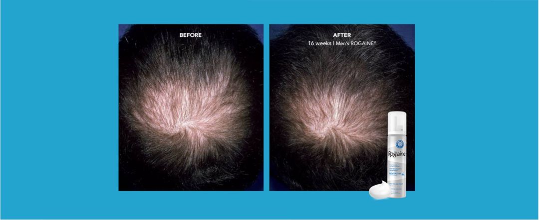 Köpük Rogaine 5% Minoxidil — Gözəllik və səhiyyə, Bakı (9)
